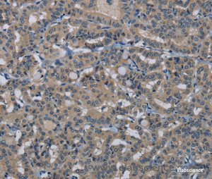 Immunohistochemistry of paraffin-embedded Human thyroid cancer tissue using HSPG2 Polyclonal Antibody at dilution 1:50