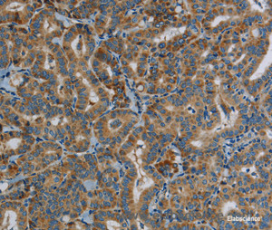 Immunohistochemistry of paraffin-embedded Human thyroid cancer tissue using PPARGC1B Polyclonal Antibody at dilution 1:30