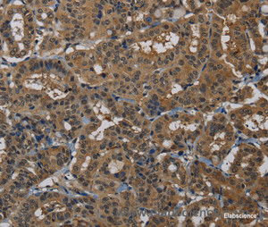 Immunohistochemistry of paraffin-embedded Human thyroid cancer tissue using PNN Polyclonal Antibody at dilution 1:50