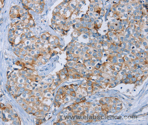 Immunohistochemistry of paraffin-embedded Human breast cancer tissue using MUC1 Polyclonal Antibody at dilution 1:45