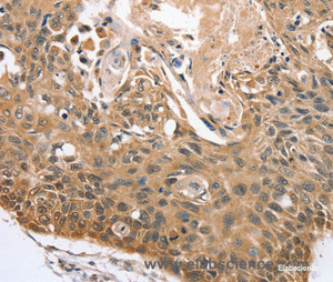 Immunohistochemistry of paraffin-embedded Human esophagus cancer tissue using RBM38 Polyclonal Antibody at dilution 1:45