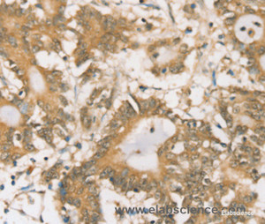 Immunohistochemistry of paraffin-embedded Human colon cancer tissue using SIGLEC15 Polyclonal Antibody at dilution 1:35