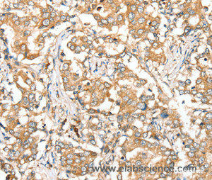 Immunohistochemistry of paraffin-embedded Human liver cancer tissue using SIRT4 Polyclonal Antibody at dilution 1:35
