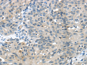 Immunohistochemistry of paraffin-embedded Human breast cancer using GLP2R Polyclonal Antibody at dilution of 1/30