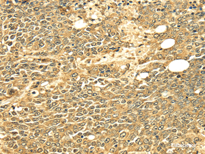 Immunohistochemistry of paraffin-embedded Human ovarian cancer using ECE2 Polyclonal Antibody at dilution of 1/25