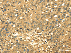 Immunohistochemistry of paraffin-embedded Human breast cancer using RPA2 Polyclonal Antibody at dilution of 1/45
