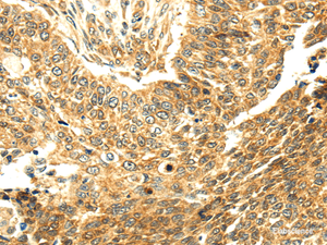Immunohistochemistry of paraffin-embedded Human lung cancer tissue using SERPINA12 Polyclonal Antibody at dilution 1:40