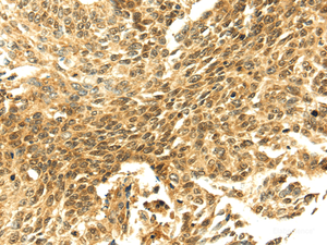 Immunohistochemistry of paraffin-embedded Human lung cancer tissue using SHPRH Polyclonal Antibody at dilution 1:40