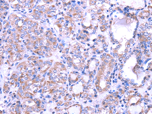 Immunohistochemistry of paraffin-embedded Human thyroid cancer tissue using SRPK1 Polyclonal Antibody at dilution 1:35