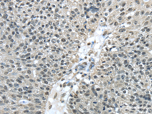 Immunohistochemistry of paraffin-embedded Human breast cancer tissue using FUS Polyclonal Antibody at dilution 1:40