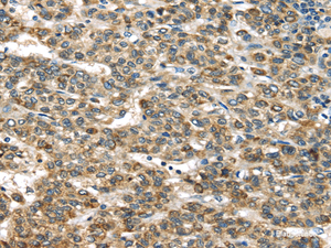 Immunohistochemistry of paraffin-embedded Human liver cancer tissue using TNFAIP2 Polyclonal Antibody at dilution 1:40