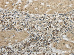 Immunohistochemistry of paraffin-embedded Human gastric cancer tissue using TRIB2 Polyclonal Antibody at dilution 1:45