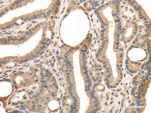 Immunohistochemistry of paraffin-embedded Human thyroid cancer tissue using TRIB3 Polyclonal Antibody at dilution 1:40
