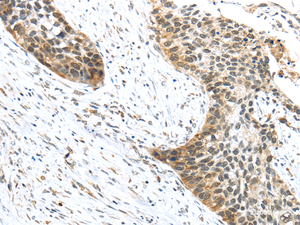 Immunohistochemistry of paraffin-embedded Human esophagus cancer tissue using TRIP6 Polyclonal Antibody at dilution 1:50