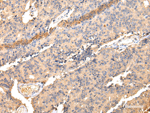 Immunohistochemistry of paraffin-embedded Human prostate cancer using SDCBP Polyclonal Antibody at dilution of 1/40