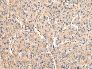 Immunohistochemistry of paraffin-embedded Human liver cancer tissue using VCAM1 Polyclonal Antibody at dilution 1:30