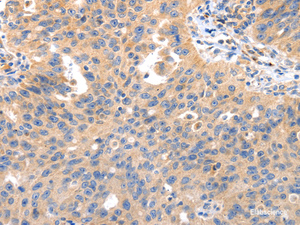 Immunohistochemistry of paraffin-embedded Human ovarian cancer tissue using IRS2 Polyclonal Antibody at dilution 1:50
