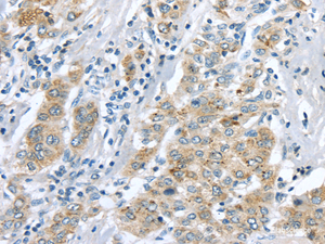 Immunohistochemistry of paraffin-embedded Human liver cancer tissue using LRP6 Polyclonal Antibody at dilution 1:60