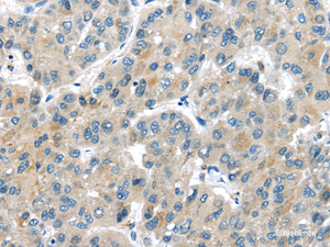 Immunohistochemistry of paraffin-embedded Human liver cancer tissue using MASP2 Polyclonal Antibody at dilution 1:35