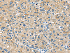 Immunohistochemistry of paraffin-embedded Human liver cancer tissue using ABCC2 Polyclonal Antibody at dilution 1:45