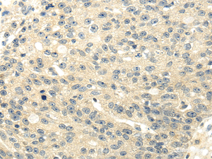 Immunohistochemistry of paraffin-embedded Human breast cancer using GAD1 Polyclonal Antibody at dilution of 1/20