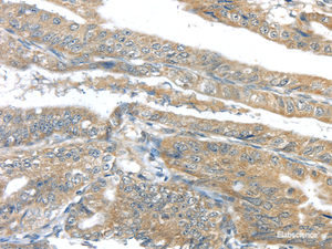 Immunohistochemistry of paraffin-embedded Human esophagus cancer tissue using AKT2 Polyclonal Antibody at dilution 1:40