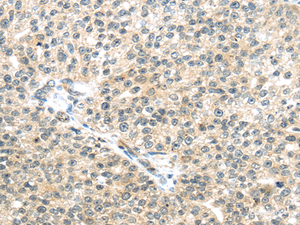 Immunohistochemistry of paraffin-embedded Human breast cancer tissue using TTBK2 Polyclonal Antibody at dilution 1:45