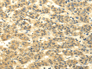 Immunohistochemistry of paraffin-embedded Human liver cancer using MSI1 Polyclonal Antibody at dilution of 1/35