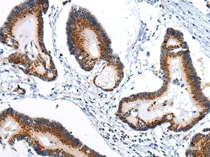 Immunohistochemistry of paraffin-embedded Human colorectal cancer using ARFGAP2 Polyclonal Antibody at dilution of 1/25