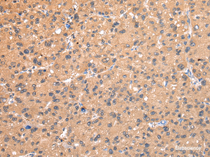 Immunohistochemistry of paraffin-embedded Human liver cancer using AP2A1 Polyclonal Antibody at dilution of 1/20