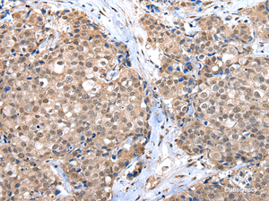 Immunohistochemistry of paraffin-embedded Human breast cancer tissue using CTBP1 Polyclonal Antibody at dilution 1:65