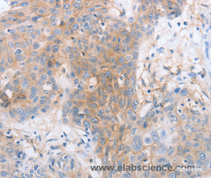 Immunohistochemistry of paraffin-embedded Human esophagus cancer tissue using CD85d Polyclonal Antibody at dilution 1:30