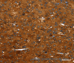 Immunohistochemistry of paraffin-embedded Human liver cancer tissue using FGFR3 Polyclonal Antibody at dilution 1:35