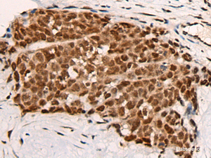 Immunohistochemistry of paraffin-embedded Human thyroid cancer tissue using HGH1 Polyclonal Antibody at dilution of 1:45 (×200)