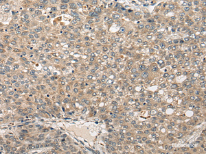 Immunohistochemistry of paraffin-embedded Human liver cancer tissue using FUT4 Polyclonal Antibody at dilution of 1:40 (×200)