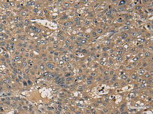 Immunohistochemistry of paraffin-embedded Human liver cancer tissue using CD1B Polyclonal Antibody at dilution of 1:55 (×200)