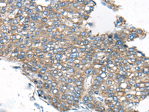 Immunohistochemistry of paraffin-embedded Human liver cancer tissue using CDC42BPA Polyclonal Antibody at dilution of 1:60 (×200)