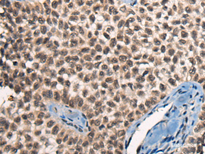 Immunohistochemistry of paraffin-embedded Human ovarian cancer tissue using CITED2 Polyclonal Antibody at dilution of 1:50 (×200)
