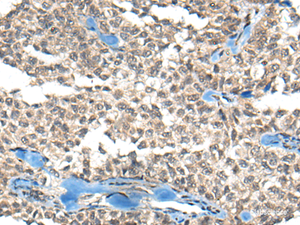 Immunohistochemistry of paraffin-embedded Human ovarian cancer tissue using REST Polyclonal Antibody at dilution of 1:50 (×200)