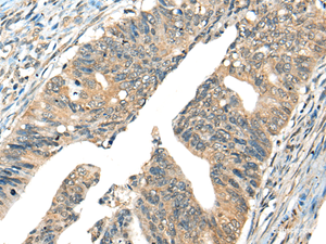 Immunohistochemistry of paraffin-embedded Human colorectal cancer tissue using AIFM2 Polyclonal Antibody at dilution of 1:40 (×200)