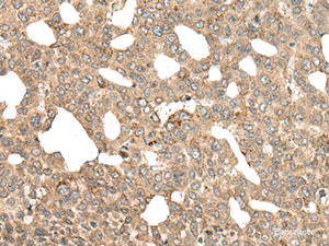 Immunohistochemistry of paraffin-embedded Human liver cancer tissue using APC Polyclonal Antibody at dilution of 1:45 (×200)
