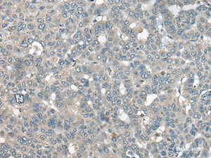 Immunohistochemistry of paraffin-embedded Human liver cancer tissue using UCN3 Polyclonal Antibody at dilution of 1:55 (×200)