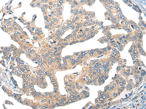 Immunohistochemistry of paraffin-embedded Human liver cancer tissue using GPR55 Polyclonal Antibody at dilution of 1:55 (×200)