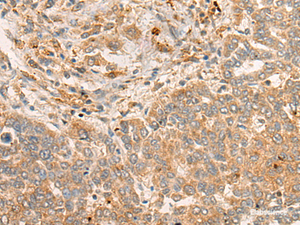 Immunohistochemistry of paraffin-embedded Human liver cancer tissue using FBXO32 Polyclonal Antibody at dilution of 1:45 (×200)