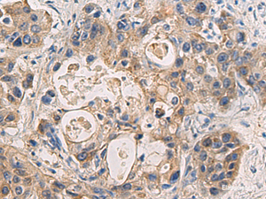 Immunohistochemistry of paraffin-embedded Human liver cancer tissue using DMRTA2 Polyclonal Antibody at dilution of 1:50 (×200)