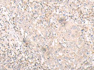 Immunohistochemistry of paraffin-embedded Human cervical cancer tissue using IL24 Polyclonal Antibody at dilution of 1:30 (×200)