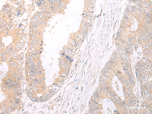 Immunohistochemistry of paraffin-embedded Human colorectal cancer tissue using HLA-C Polyclonal Antibody at dilution of 1:25 (×200)