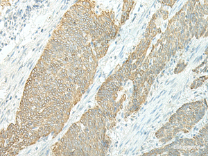Immunohistochemistry of paraffin-embedded Human esophagus cancer tissue using ETAA1 Polyclonal Antibody at dilution of 1:25 (×200)