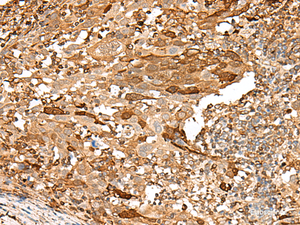 Immunohistochemistry of paraffin-embedded Human cervical cancer tissue using PIEZO2 Polyclonal Antibody at dilution of 1:55 (×200)
