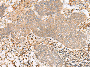 Immunohistochemistry of paraffin-embedded Human esophagus cancer tissue using FBXW8 Polyclonal Antibody at dilution of 1:65 (×200)